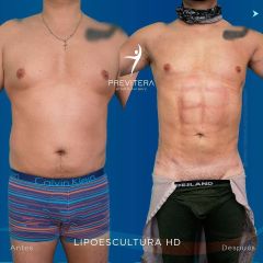 Liposucción - Dr. Antonio Previtera