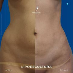 Liposucción - Dr. Antonio Previtera