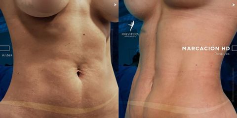 Liposucción - Dr. Antonio Previtera