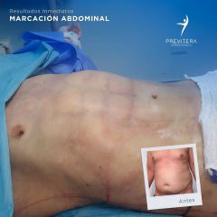 Liposucción - Dr. Antonio Previtera