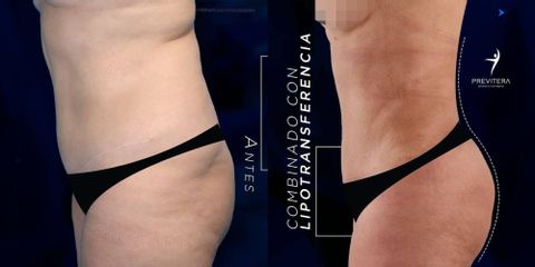 Liposucción - Dr. Antonio Previtera