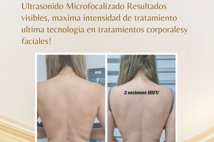 HIFU antes y después - 868115