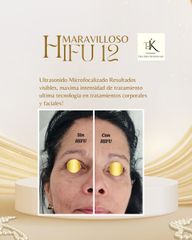 Hifu 12 - Dermakinesic