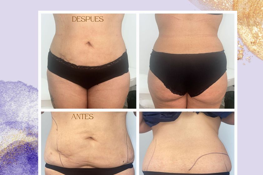 Carboxiterapia antes y después - 868118