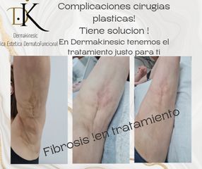 Tratamiento Fibrosis brazos - Dermakinesic