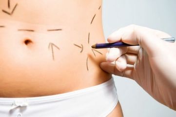 Liposucción