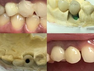 Implantes dentales - 637337