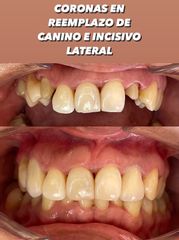 Carillas de porcelana - Smile Odontología Integral