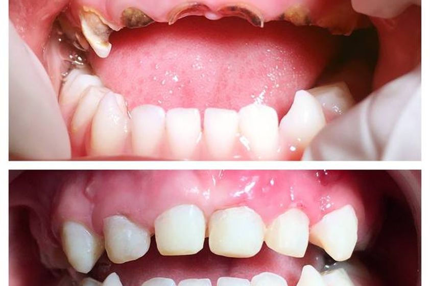 Carillas dentales antes y después - 558743