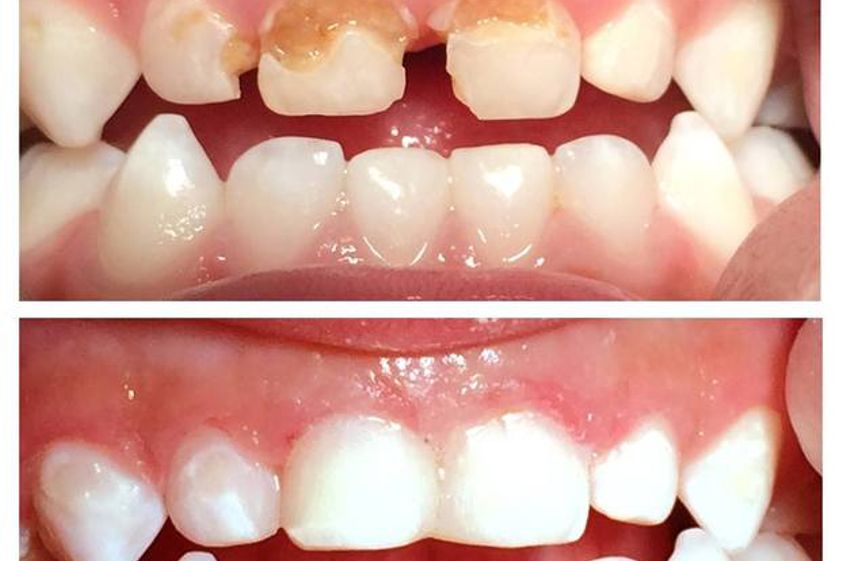 Endodoncia antes y después - 558744