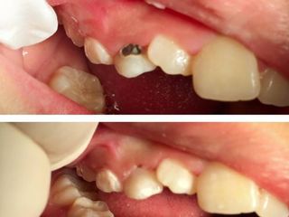 Caries crónica