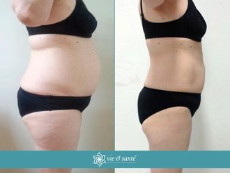 Dieta antes y después - 592831
