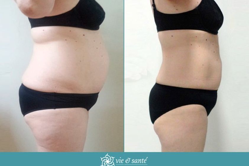 Dieta antes y después - 592831