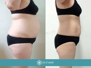 Antes y después Metod Vie et Santé