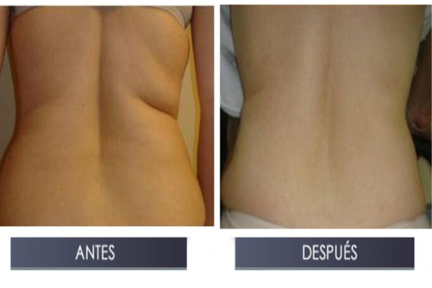 Cavitación antes y después - 493907