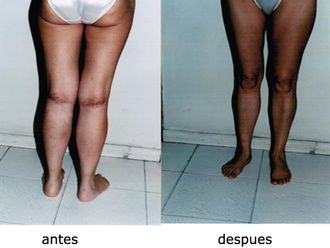 Aumento de pantorrilla antes y después - 493908