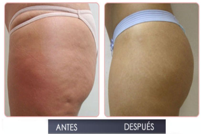 Tratamiento celulitis antes y después - 493920