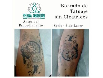 Borrar tatuajes - 641530