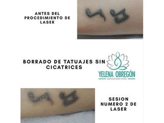 Borrar tatuajes