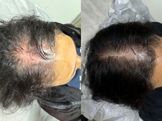 Alopecia antes y después - 868817