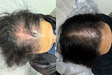 Alopecia