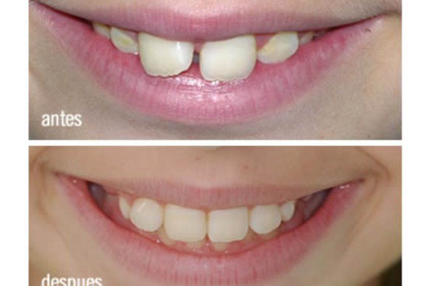 Odontopediatría antes y después - 500472