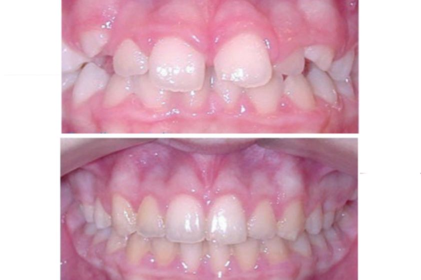 Odontopediatría antes y después - 500473