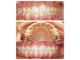 Ortodoncia lingual