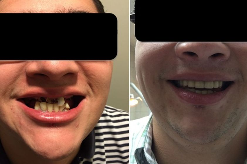 Prótesis dentales antes y después - 568093