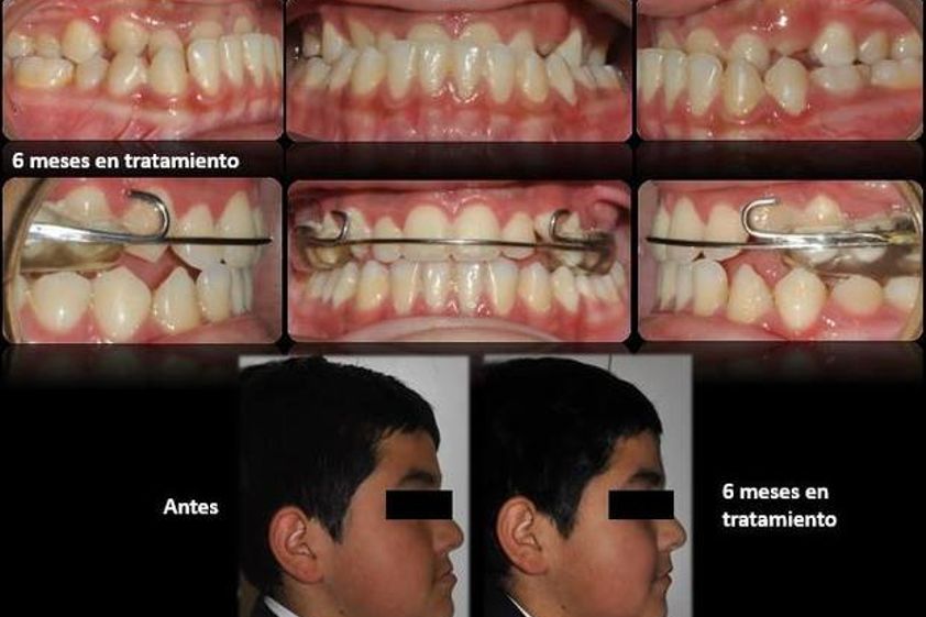 Brackets antes y después - 572836