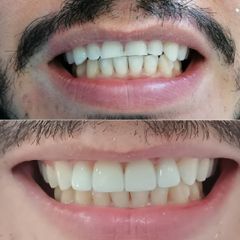 Carillas dentales - Centro Dr. Marco Álvarez Olivares