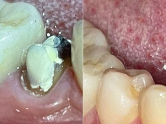 Prótesis dentales antes y después - 871700