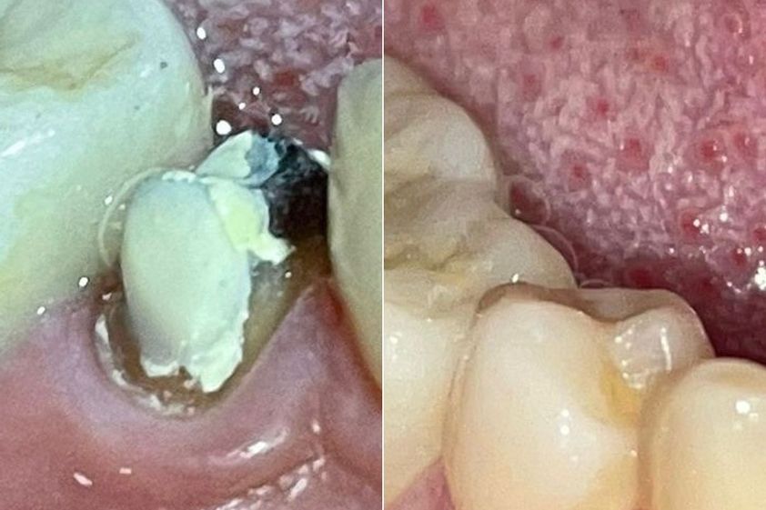 Prótesis dentales antes y después - 871700