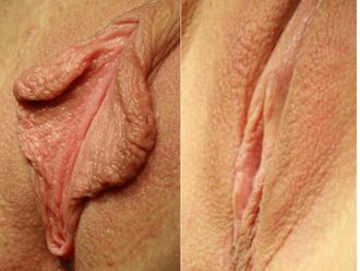 Labioplastia - 530548