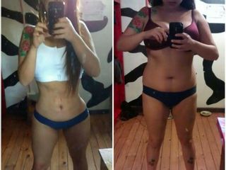 Lipoescultura HD con implante mamario