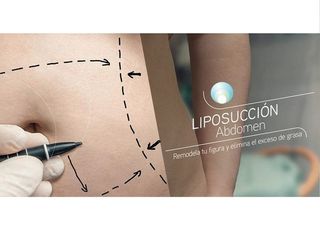 Liposuccion abdomen. 