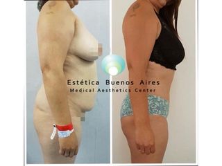 Abdominoplastia