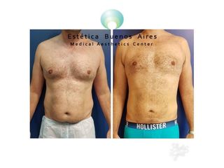 Abdominoplastia