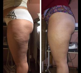 Amarna Médica Estética - Tratamiento celulitis