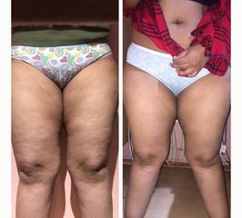 Amarna Médica Estética - Tratamiento celulitis
