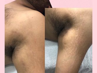 Eliminar las estrías antes y después - 661704