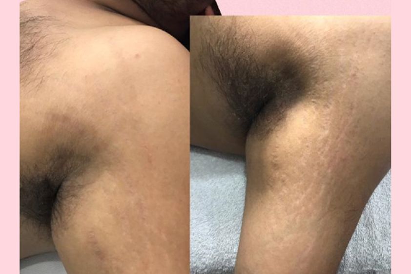 Eliminar las estrías antes y después - 661704