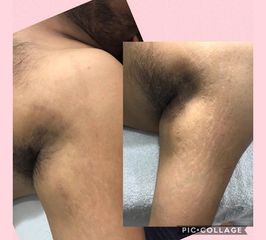 Amarna Médica Estética - Eliminación de Estrías