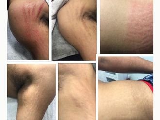 Eliminar las estrías antes y después - 661705