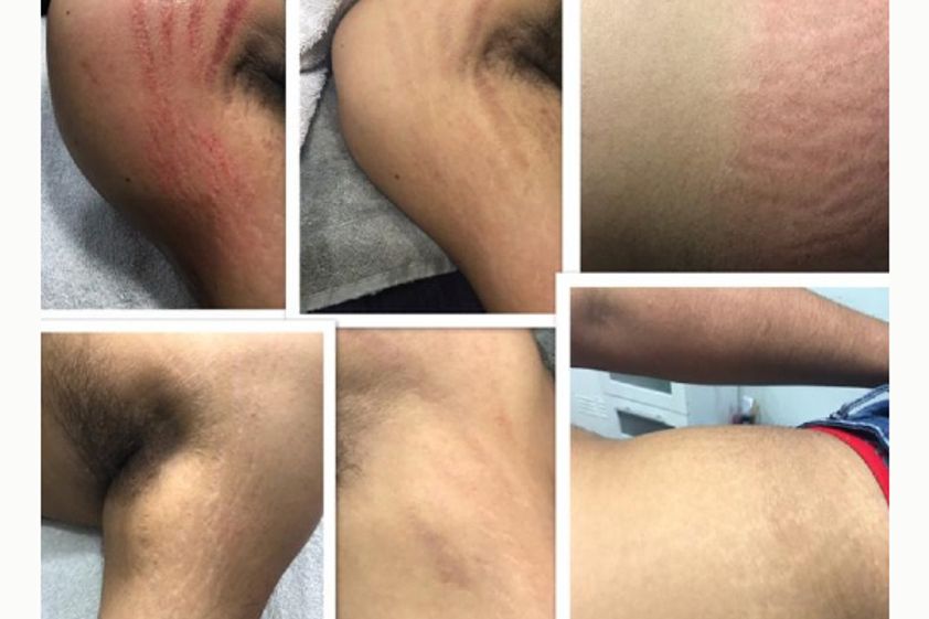 Eliminar las estrías antes y después - 661705