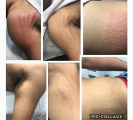 Amarna Médica Estética - Eliminación de estrías