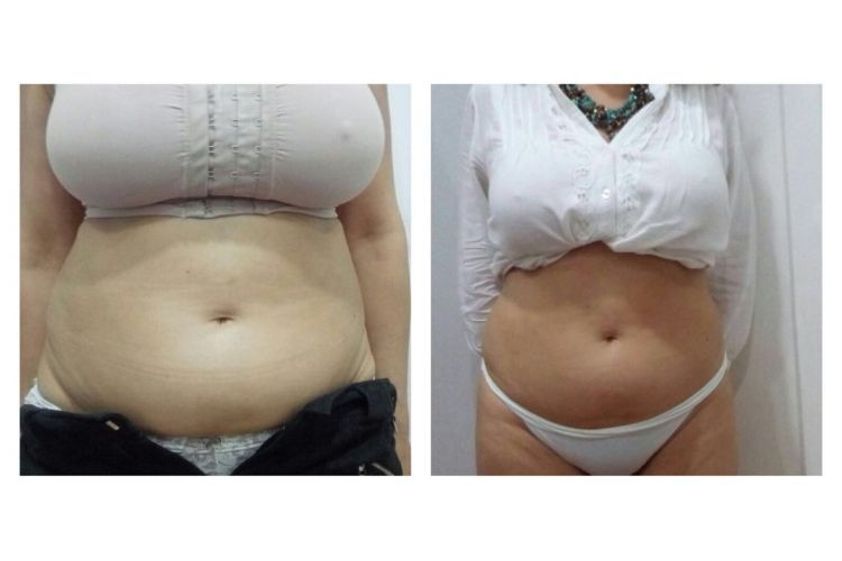 Criolipólisis antes y después - 663915