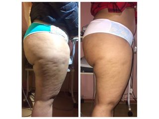Celulitis - Amarna Médica Estética