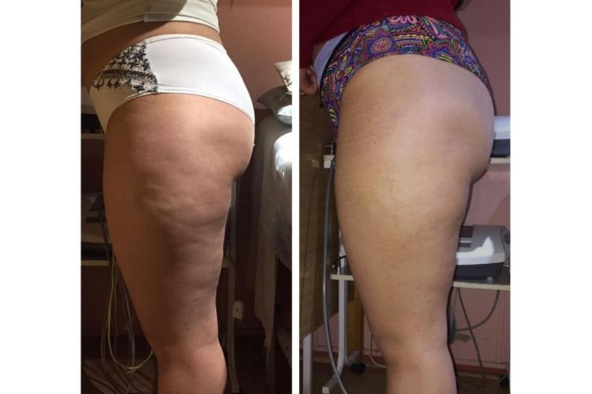 Tratamiento celulitis antes y después - 663917