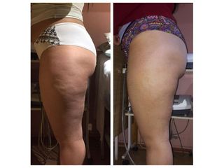 Celulitis - Amarna Médica Estética